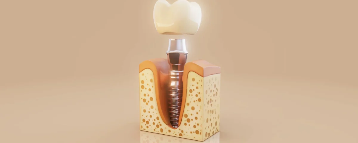 راهنمای ایمپلنت CMI برای جایگزینی دندان 2 راهنمای ایمپلنت CMI برای جایگزینی دندان