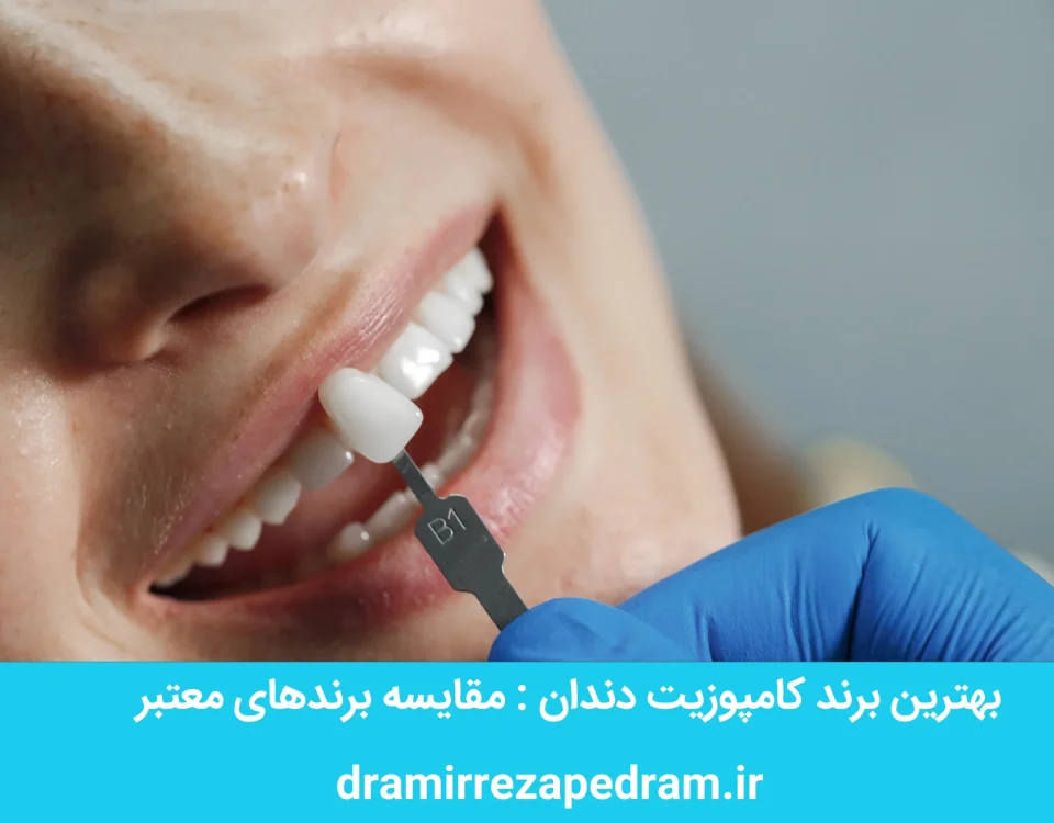 بهترین برند کامپوزیت دندان
