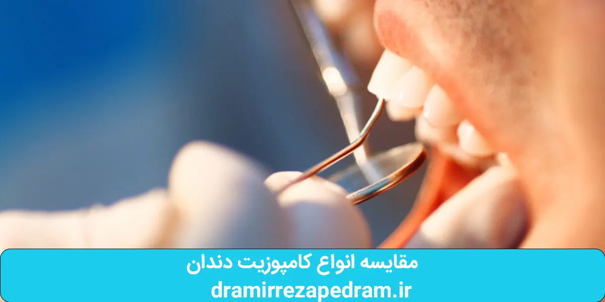 مقایسه انواع کامپوزیت دندان 3 مقایسه انواع کامپوزیت دندان